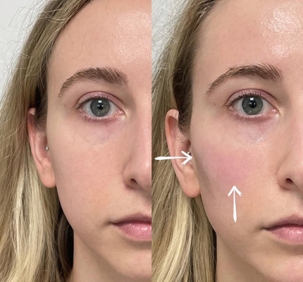 Enchimentos cutâneos ácidos hialurónicos profundos dos bordos 2ml de Skinject injetáveis