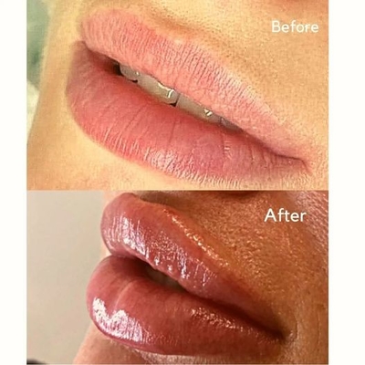 Injeção injetável Juvederms do enchimento enchimento cutâneo de ultra 3 HA para o volume do bordo