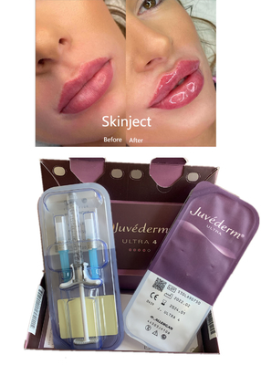 Os bordos remodelam o enchimento cutâneo ácido hialurónico de Juvederm com Lido Ultra4 2X1ml