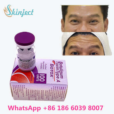 Toxina Botulinum Allergan antienvelhecimento  na linha anti enrugamento da compra