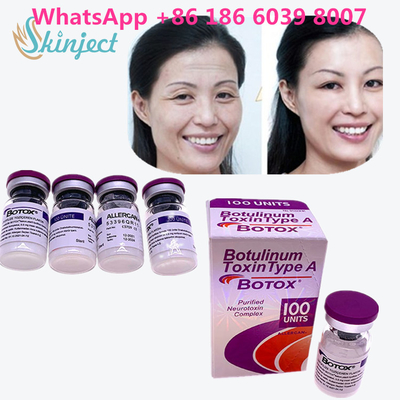 A toxina Botulinum  enruga a remoção 100u Allergan 100 unidades para a injeção da face lift