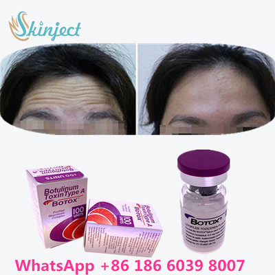 A toxina Botulinum  enruga a remoção 100u Allergan 100 unidades para a injeção da face lift