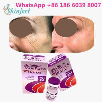 Toxina Botulinum Allergan s 1x100iu para enrugamentos faciais