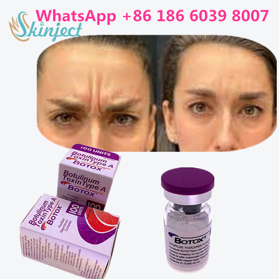 Tipo Botulinum A da toxina de Allergan  para produtos antienvelhecimento da pele