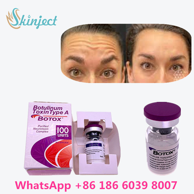 A toxina Botulinum original  100u de 100% para remove os enrugamentos
