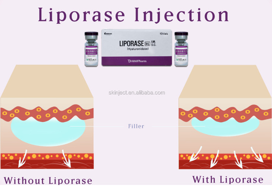 Hyaluronidase de 10 Vias Liporase para que o enchimento cutâneo dissolva-se