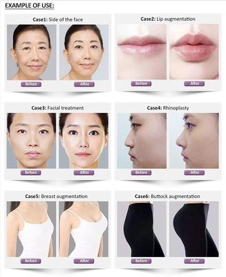 enchimento cutâneo hialurónico profundo de 1.1ml Revolax para a cara