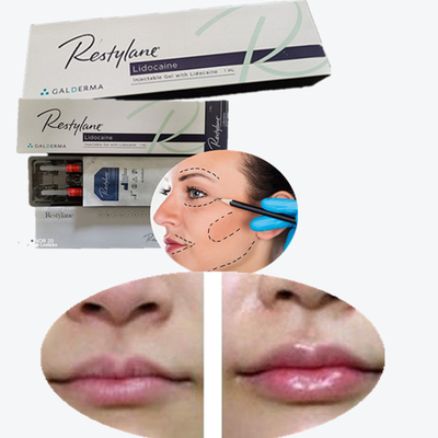 Enchimento Facial Injetável de Ácido Hialurónico LIDO LYFT Enchimentos Dermológicos