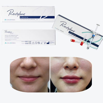 Enchimento Facial Injetável de Ácido Hialurónico LIDO LYFT Enchimentos Dermológicos