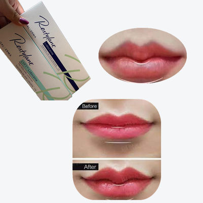 2*1 ml/ caixa de enchimento cutâneo para aumento dos lábios