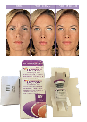 Injecções Allergan Toxina Botulínica 100IU Anti- Rugas Preenchimento Dermológico