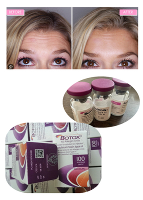 Anti-rugas Toxina Botulínica Allergan 100IU 150iu Injecções de  ' Na