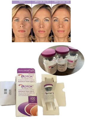 Anti-rugas  Botulinum Toxin Allergan 100IU 150iu ' Na