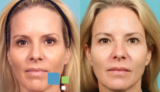 3D PLLA Filler para Injeção para Regeneração de Colágeno Facial