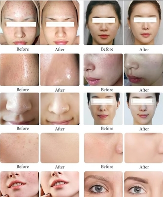 Black Pearl Skin Eye Management Hidrogénio Oxigénio Bolhas de limpeza da pele Moisturizante Máquina de beleza