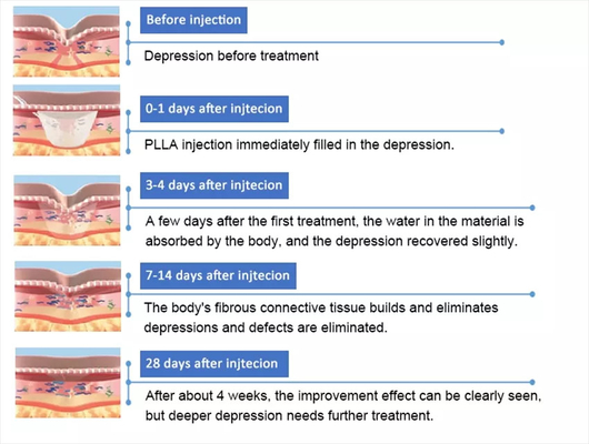 PLLA Ácido Poli- L- Láctico Injecção Facial 10 Frascos 150 mg