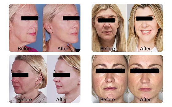 PLLA Ácido Poli- L- Láctico Injecção Facial 10 Frascos 150 mg