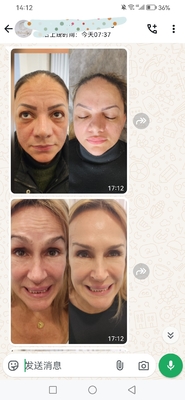 Dysport Cosmético 500 Unidades Toxina Botulínica 500 UI Pó para Injecção