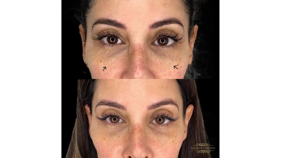 135 ha Nctf 3 ml*5 frascos para injectáveis
