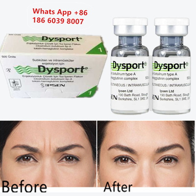 Toxina Botulínica A Dysport Injetável Botox para Aumento do Queixo