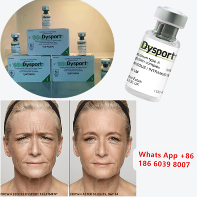 Dysport 500u Toxina Botulínica Tipo A para Melhoria de Bochechas
