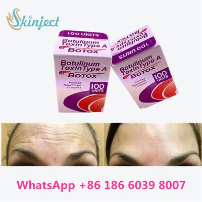 Toxina Botulínica Tipo A Allergan Botox 100 Unidades para Remoção de Rugas com Duração de 4 a 6 Meses