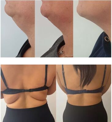 Solução de dissolvimento de gordura de garrafa de limão natural Solução lipolítica