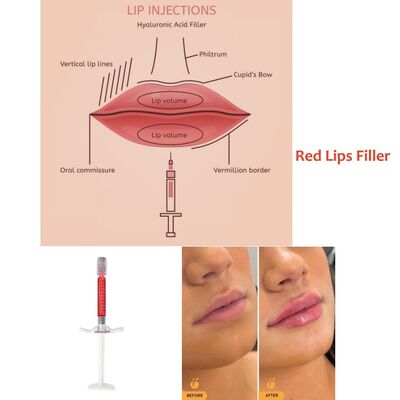 Tempo de Recuperação Imediata Revolax Deep Filler Excelente para Preenchimento Labial Proporcionando Resultados Naturais e Tempo de Recuperação Mínimo