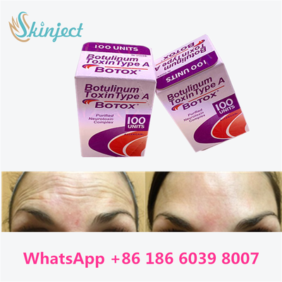 Toxina Botulínica Alérgico BOTOX Injecção Cosmética 100 Unidades para linhas Glabellares