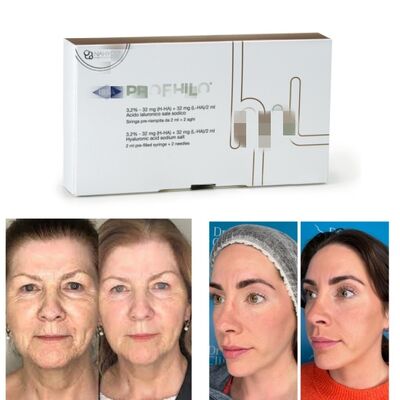 Tratamento Profhilo Ácido Hialurónico Skin Booster & Bio-Remodelação