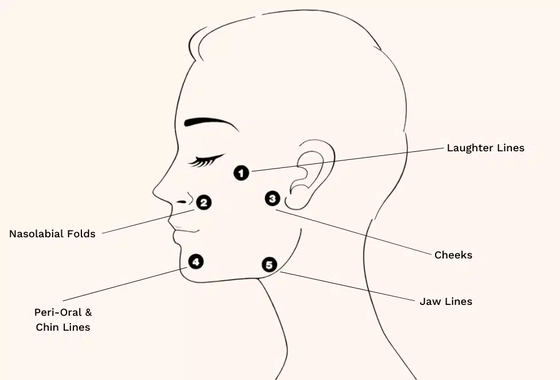 Tratamento Profhilo Ácido Hialurónico Skin Booster & Bio-Remodelação