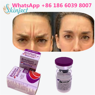 Toxina Botulínica BOTOX Cosmético 100 Unidades Alergênico OnabotulinumtoxinA para rugas faciais
