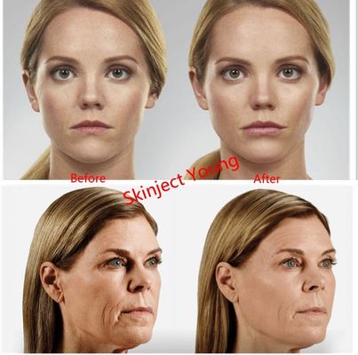 Enchimentos injetáveis ácidos hialurónicos do gel de Juvederm Voluma 2x1ml