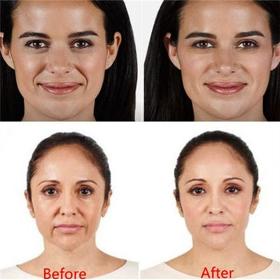 Enrugamentos ácidos hialurónicos de Juvaderm Voluma Pen Filler For Forehead Eyes