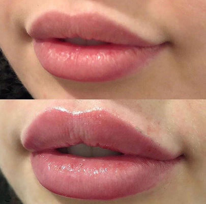 Bordos Juvederm ultra 3 do russo com enchimento cutâneo ligado cruz do