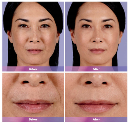 Injeção cutânea ultra 4 do bordo do enchimento de Juvederm para a ampliação do bordo
