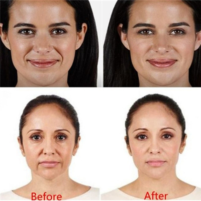 A cruz ligou a remoção ácida hialurónica do enrugamento de Juvederm do enchimento cutâneo