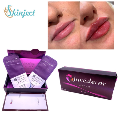 Enchimento cutâneo Nasolabial Juvederm ácido hialurónico Ultra3 dos bordos 2x1ml das dobras