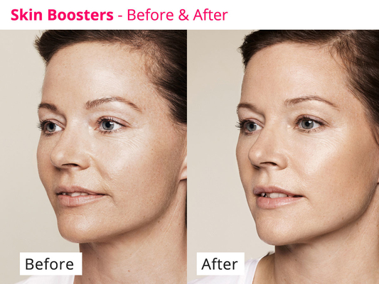Pele que rejuvenesce o soro meso de PDRN Skinbooster para a regeneração do colagênio