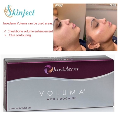 Ácido hialurónico do enchimento cutâneo de Juvederm Voluma para o contorno facial