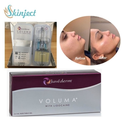 Ácido hialurónico do enchimento cutâneo de Juvederm Voluma para o mordente facial Chin Contour