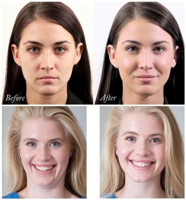 Enchimento facial ácido hialurónico de Juvederms Voluma para o aumento de Chin e de mordente