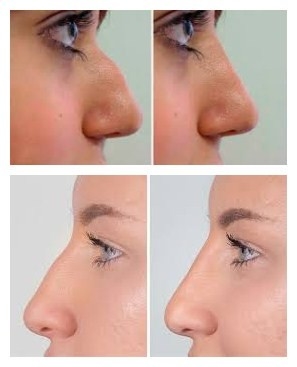Enchimento facial ácido hialurónico de Juvederms Voluma para o aumento de Chin e de mordente