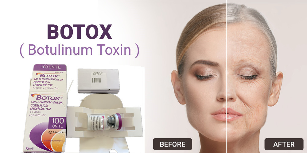 tipo Botulinum da toxina de 100Units Allergan uma injeção para a remoção facial do enrugamento