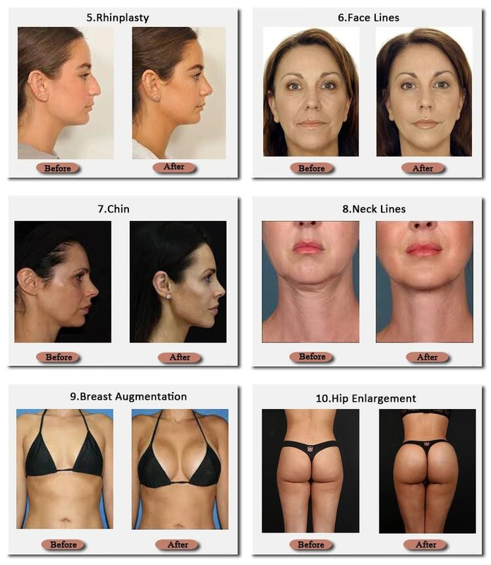 Skinjection enchimento hialurónico Technnology coreano do peito de 10 Ml e de 20 Ml 24 Mg/Ml
