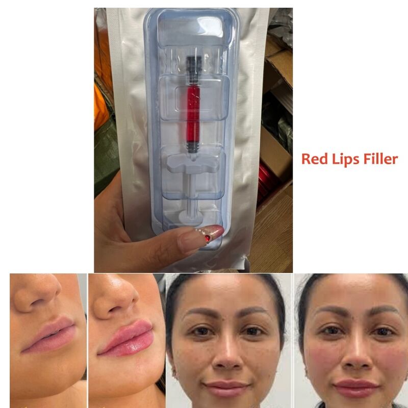 Período de validade 2 anos Gel injetável de preenchimento cutâneo concebido para redução de rugas, contorno facial e revitalização da pele