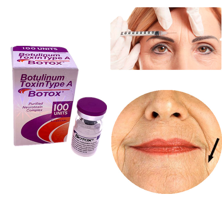 Allergan Botox 100IU Toxina Botulínica Tipo A Para Eliminação de Rugas Faciais e Oculares