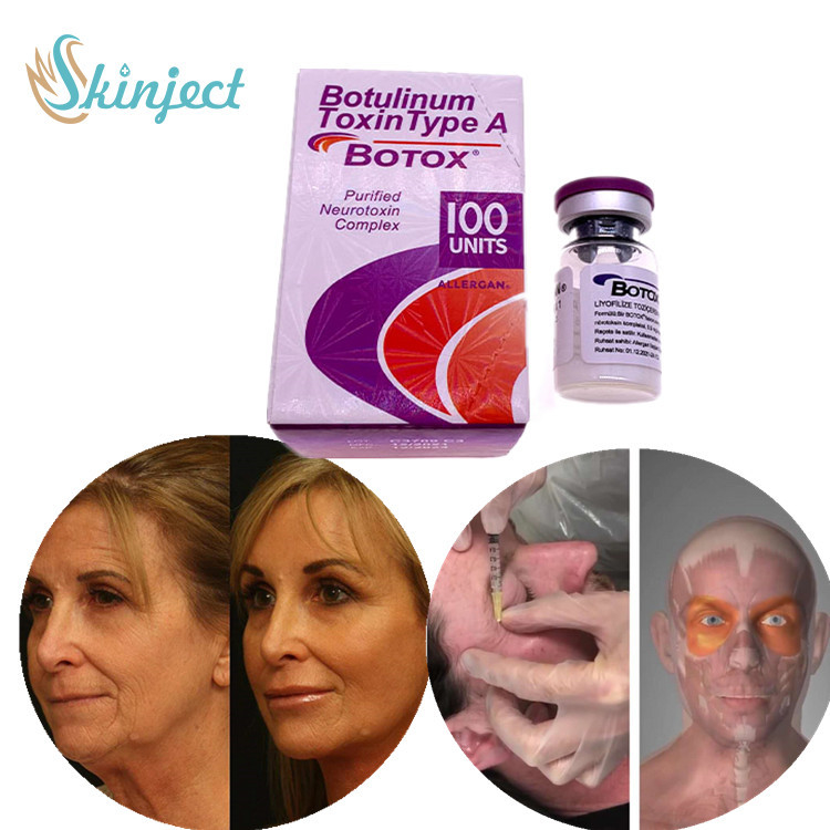 Tipo Botulinum facial da toxina uma remoção do enrugamento da injeção