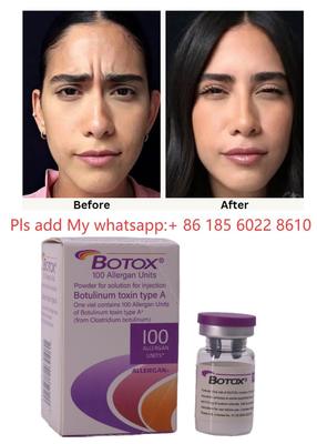 Injeção de Botox ALLERGAN Toxina Botulínica Tipo A